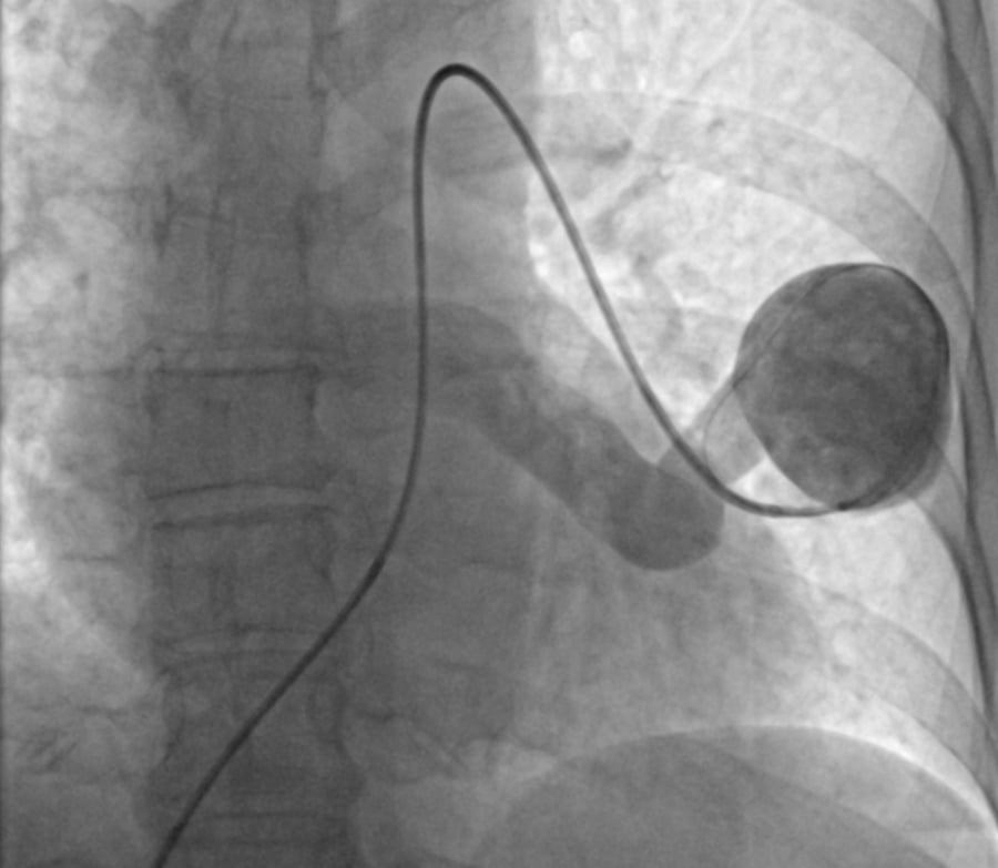 Solving a pulmonary dilemma