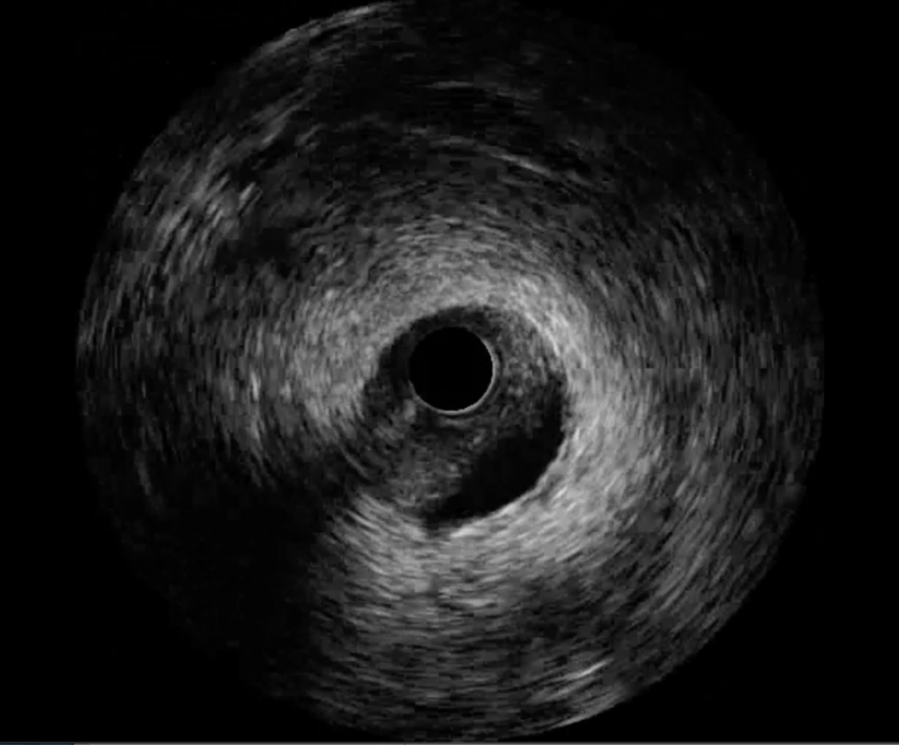 STEMI with cardiogenic shock 