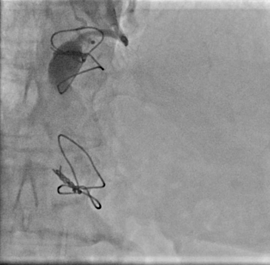 Stranger things in the CathLab