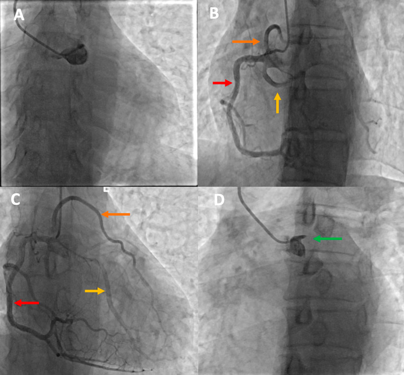 The artery that denied its origin