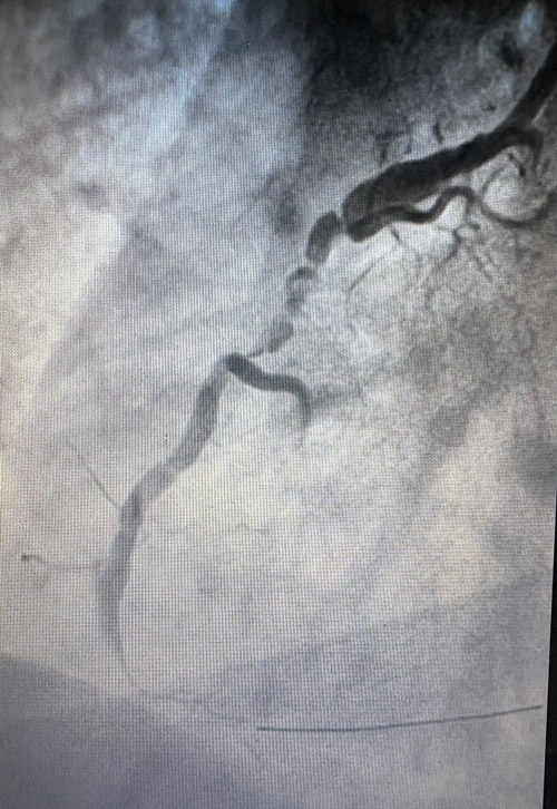 The curious case of a crooked artery