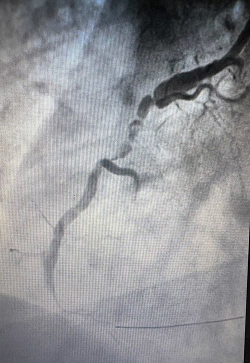 The curious case of a crooked artery