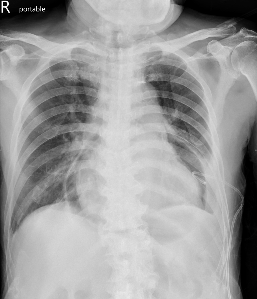The "halo" effect in cardiac amyloidosis
