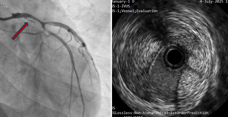 The phantom branch from the left main coronary artery