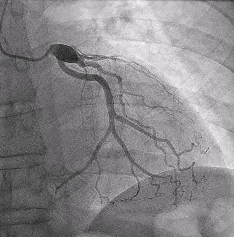 Treat, fix, or watch? A coronary conundrum