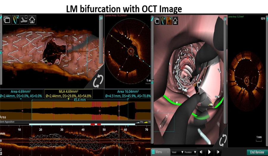 Unexpected complication during left main bifurcation PCI
