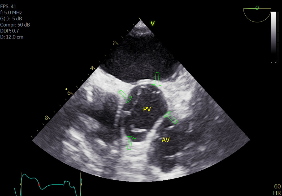 Unexpected valve anatomy in complex congenital heart disease