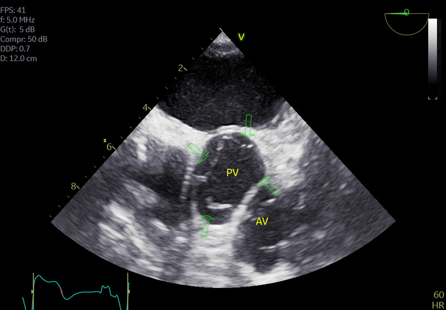 Unexpected valve anatomy in complex congenital heart disease