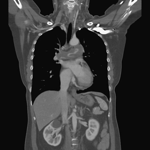 Unusual pulmonary embolism 