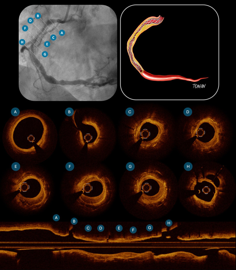 What explains coronary stent failure 26 years after implantation? Insights from OCT