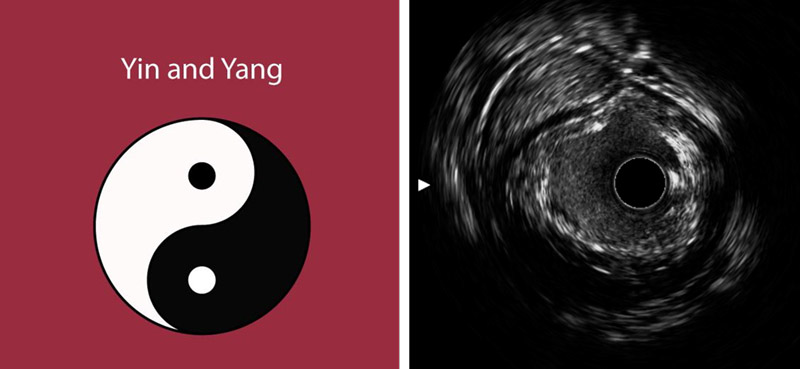 What is this Yin and Yang like appearance on IVUS?
