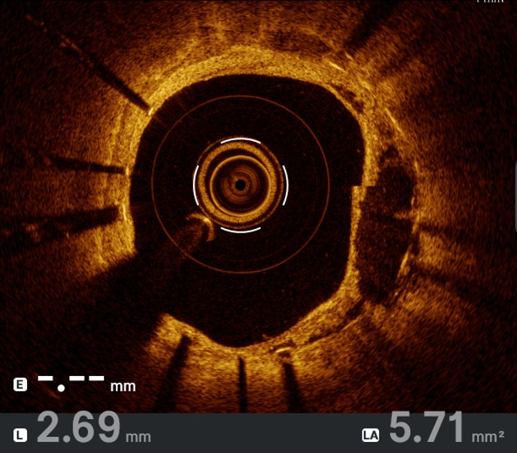 What mechanism explains “the dark side” of this late stent failure?