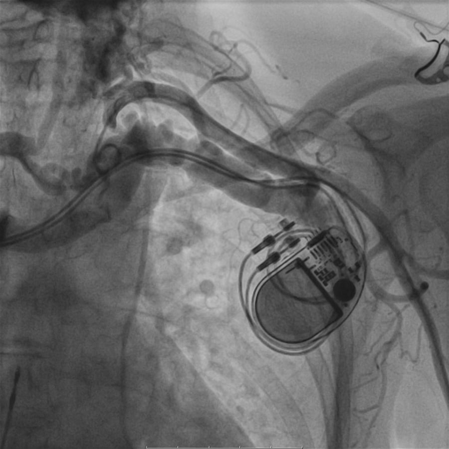 When a murmur reveals more than expected after pacemaker implantation