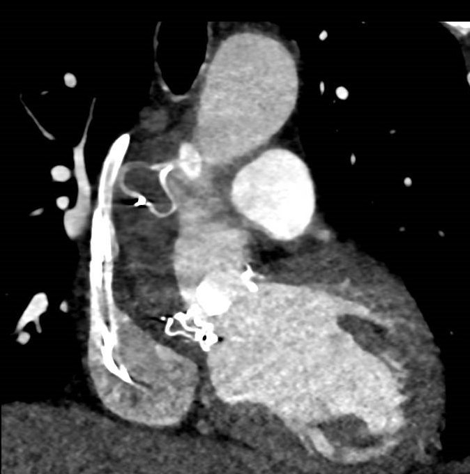 When aortic regurgitation is not what it seems