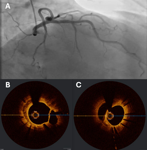 When intravascular imaging helps clarify the diagnosis