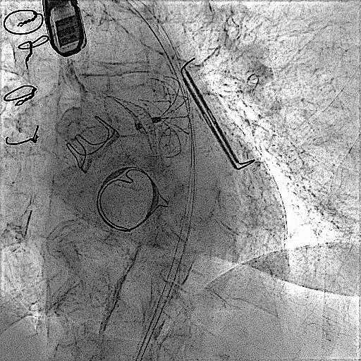 When surgery is not the end: A residual LAA challenge