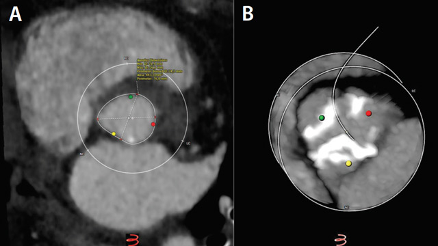 Real-world case report illustrating the benefits of the Portico with FlexNav TAVI system.