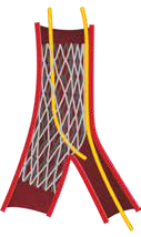 Side branch access