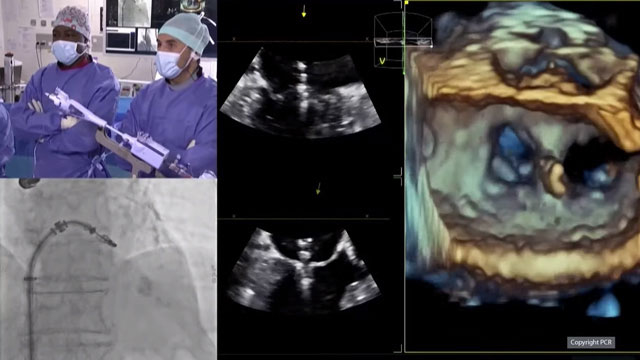 Advancing transcatheter solutions for mitral valve regurgitation - highlights from EuroPCR 2021 