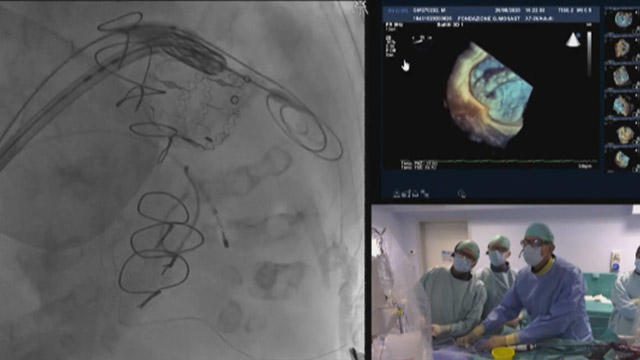 TAVI sessions from PCR London Valves 2021: Edwards Lifesciences 