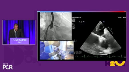 Mitral sessions from EuroPCR 2025: Abbott 
