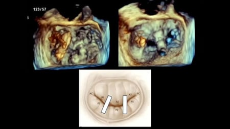 Mitral sessions from EuroPCR 2026: Abbott