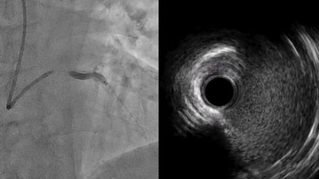 Shockwave C2 Aero: Early experience in complex calcified coronary lesions