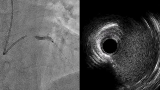 Shockwave C2 Aero: Early experience in complex calcified coronary lesions