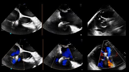 Tricuspid session from EuroPCR 2026: Abbott 