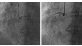 A parade of uncommon STEMI presentations