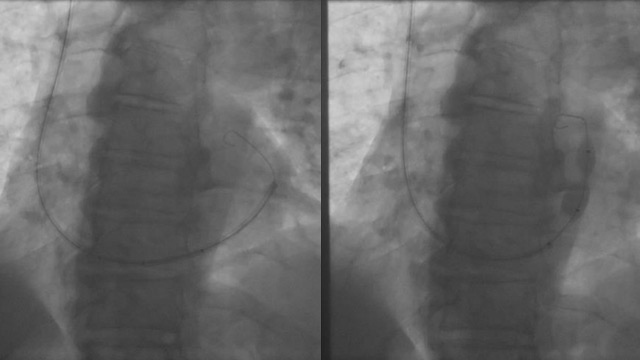 A proven evidence-based therapy when angina persists