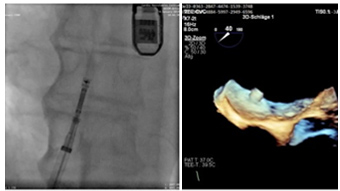 Acute/chronic heart failure: new interventional options