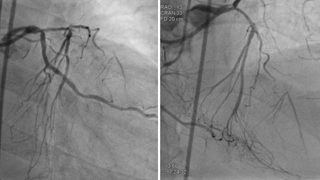 Advanced CTO interventions