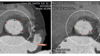 Advanced TAVI: challenges and complexities in TAVI 2019 in high-risk patients