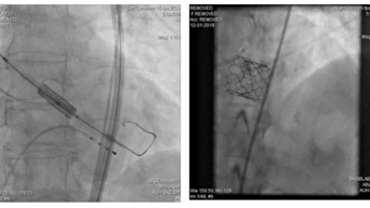All you need to know about physiological assessment of coronary artery disease