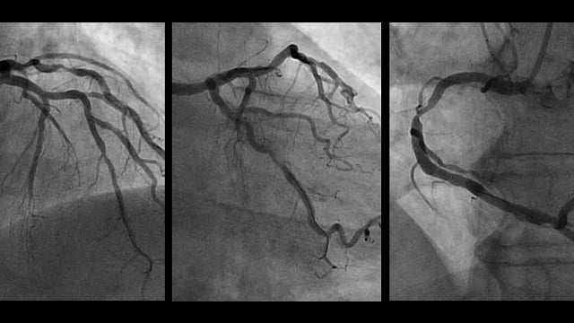 All you need to know to start optimising outcomes in PCI: OCT and physiology
