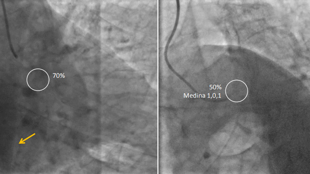 Beyond the limit – Left main PCI in high-risk patients and complex anatomy