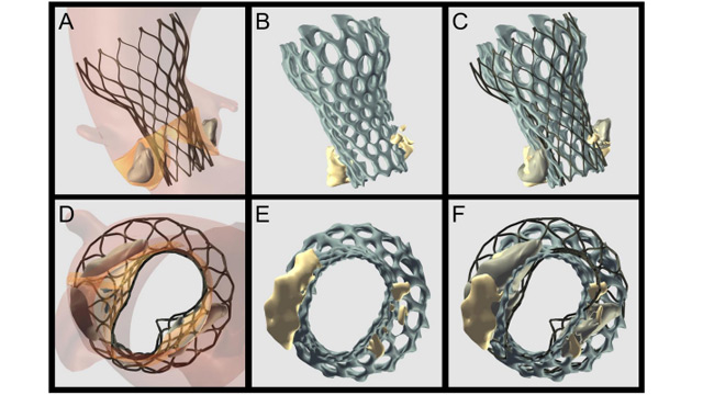 Bicuspid aortic stenosis: from imaging to TAVI