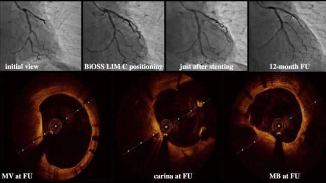 Bifurcation PCI: what's hot in 2019?