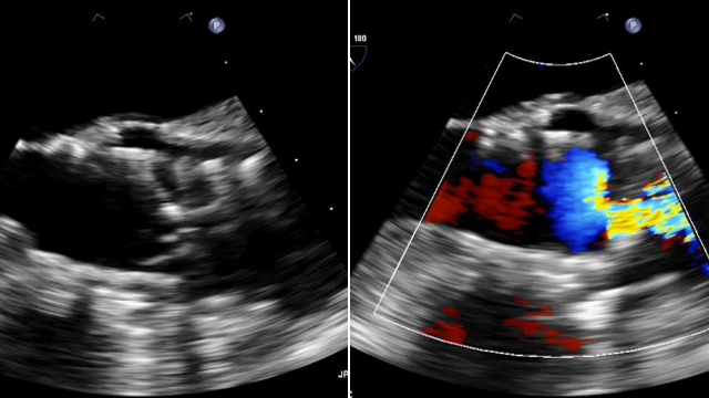 Case-based learning for the Heart Valve Team: bioprosthetic valve thrombosis