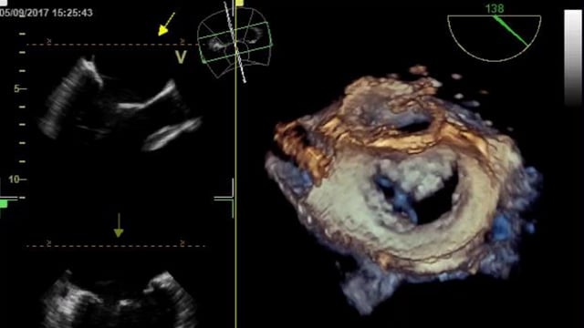 Case-based learning for the Heart Valve Team: imaging for mitral valve intervention
