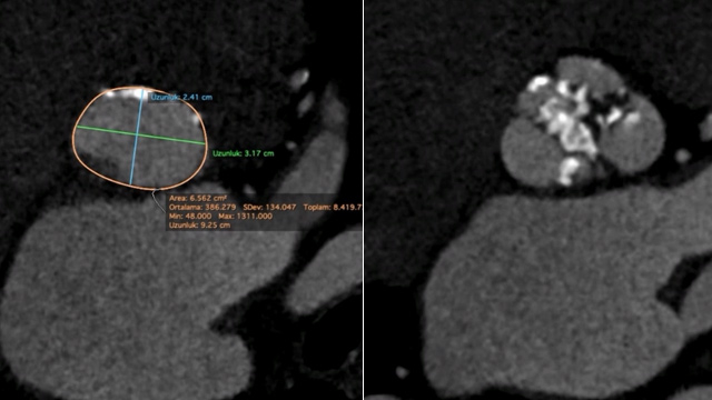 Case-based learning for the Heart Valve Team: TAVI in pure aortic regurgitation