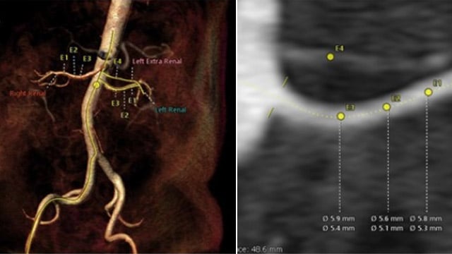 Catheter-based renal denervation – Back in routine clinical practice?
