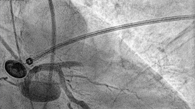 Challenging cases in primary angioplasty - from the difficult to the unusual