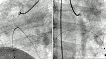 Challenging indications for coronary rotational atherectomy - Part 2