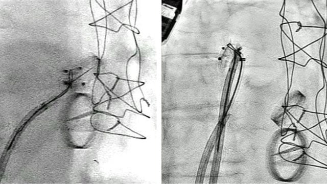Closing paravalvular leaks: learning from each other!