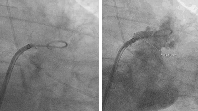 Complex anatomy and complications during LAA closure