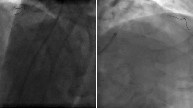 Complex CTO cases: MSCT and intracoronary imaging may help