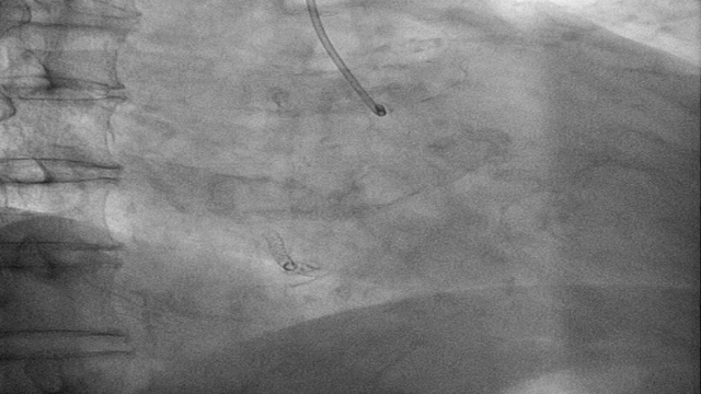 Complex left main PCI
