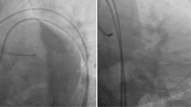 Complex left main stem interventions